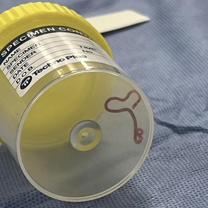 Neurosurgeon investigating patient's mystery symptoms plucks a worm from woman's brain in Australia